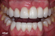 Pictures and Images of Dental Bridge Before After